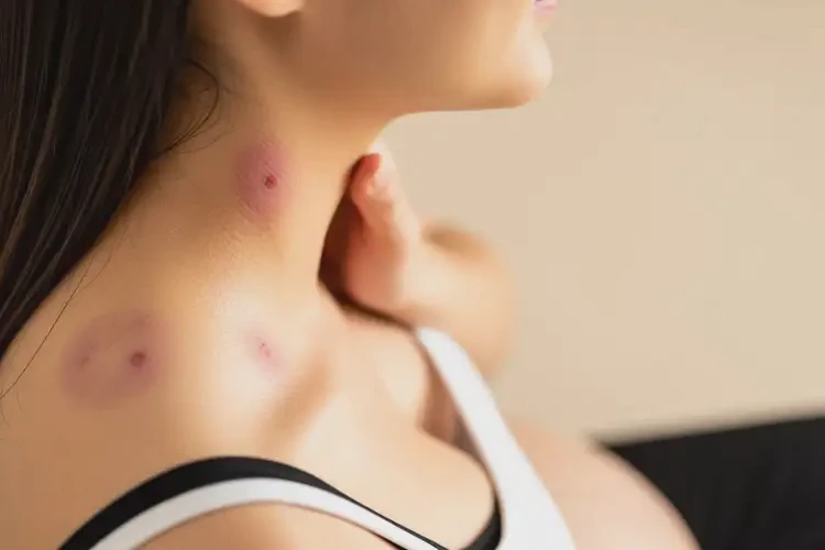 孕婦脖子上經(jīng)常起濕疹不管它會(huì)自己痊愈嗎(圖3)