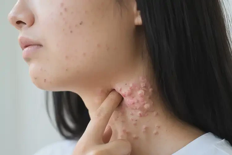 女生脖子上出現(xiàn)濕疹能徹底自愈嗎(圖4)