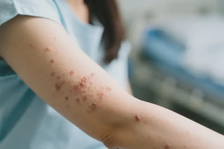 女人手臂上偶爾起濕疹能徹底自愈嗎(圖2)