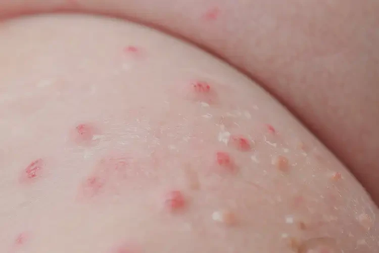 新生兒四肢經(jīng)常長(zhǎng)濕疹不管它會(huì)自己自愈嗎(圖4)