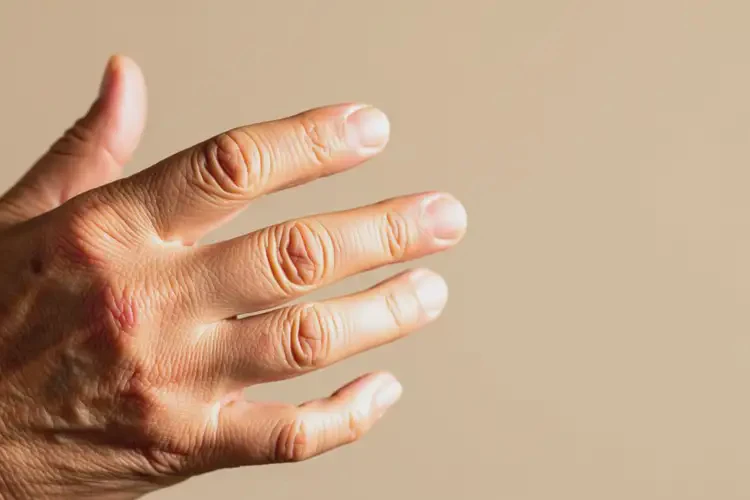 老年人身上偶爾長濕疹能不能徹底自愈(圖4)