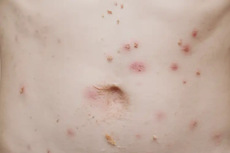 孩子肚子上長濕疹能徹底自愈嗎(圖4)