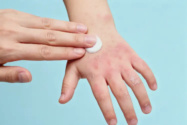 少儿手上容易长湿疹能够彻底治愈吗(图2)