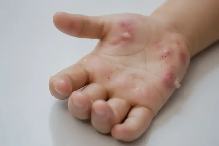 小兒手上出濕疹不管它會自己自愈嗎(圖4)