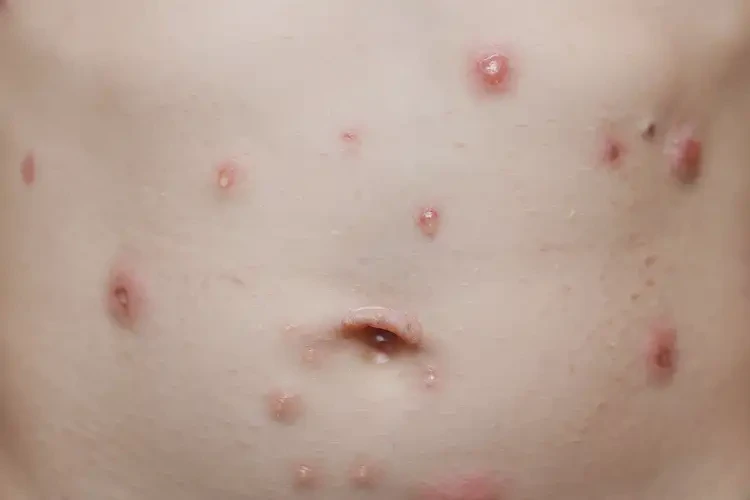 小學(xué)生肚子偶爾長濕疹不管它會自己好嗎(圖4)