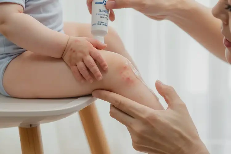 小孩全身出濕疹可以徹底自愈嗎(圖2)