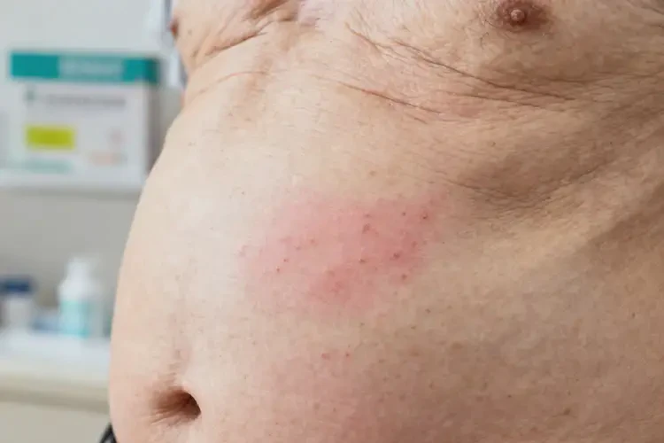 老人肚子上出現(xiàn)濕疹不管它會(huì)自己自愈嗎(圖1)