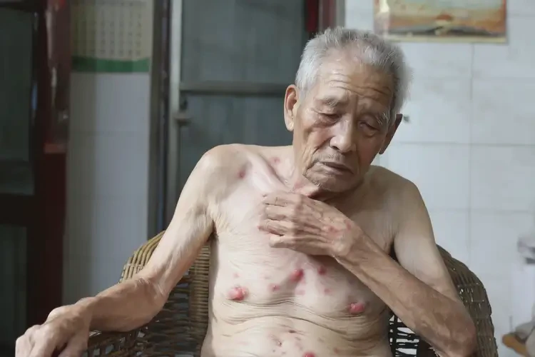 老人肚子上出濕疹不管它會(huì)自己自愈嗎(圖4)