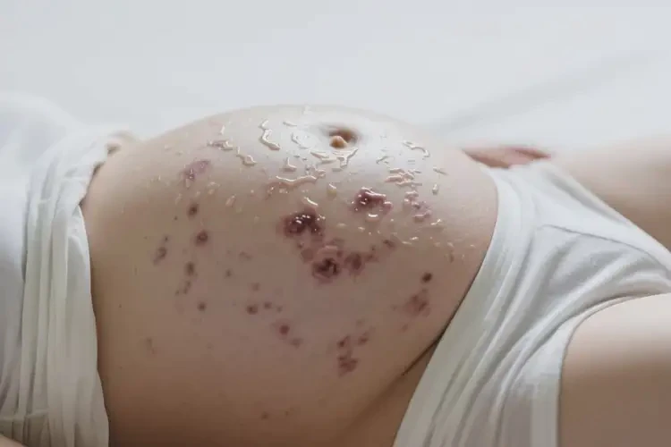 產婦肚子上有濕疹能靠自己自愈嗎(圖3)