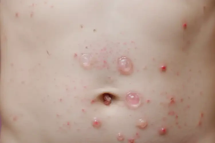 小學(xué)生肚子上容易長(zhǎng)濕疹不管它會(huì)自己好嗎(圖3)