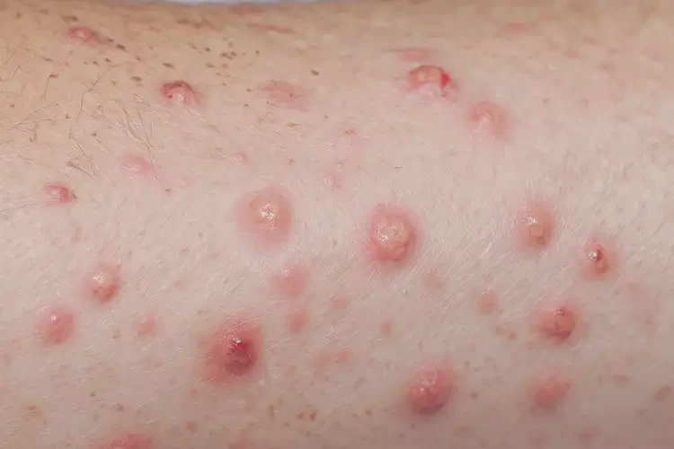 女人身上起湿疹能不能彻底自愈(图4)