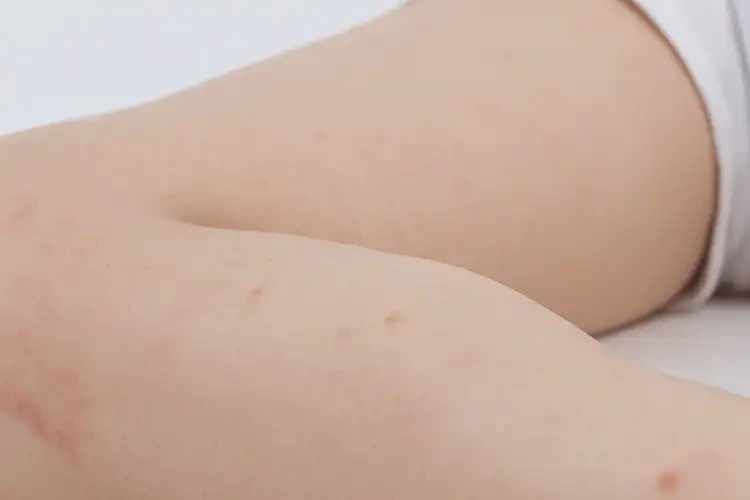 兒童大腿起濕疹可不可以徹底自愈(圖1)