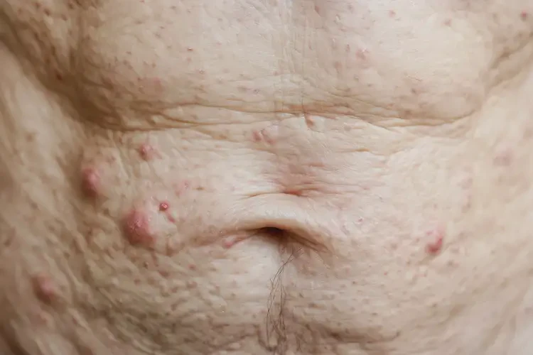 高齡老人肚子偶爾起濕疹不管它會自己痊愈嗎(圖4)