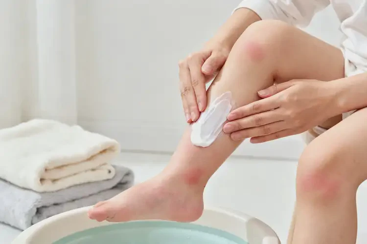 幼兒小腿經(jīng)常長濕疹不管它會自己自愈嗎(圖3)