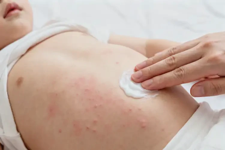 少兒肚子出濕疹不管它會自己自愈嗎(圖1)