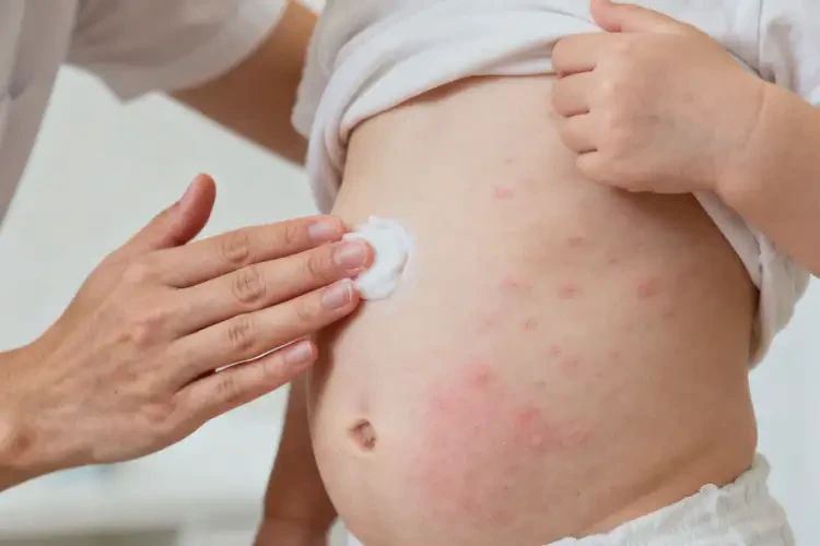 幼兒肚子長濕疹不管它會自己自愈嗎(圖3)