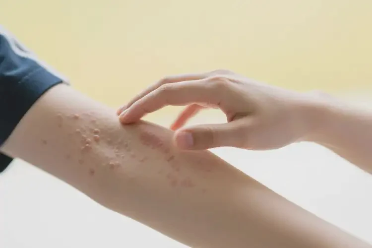 大學(xué)生手臂有濕疹可以徹底自愈嗎(圖1)