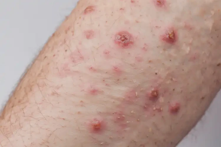 老人大腿偶尔起湿疹不管它会自己痊愈吗(图3)