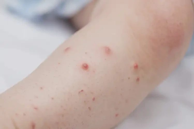 幼兒小腿上有濕疹不管它會自己好嗎(圖4)