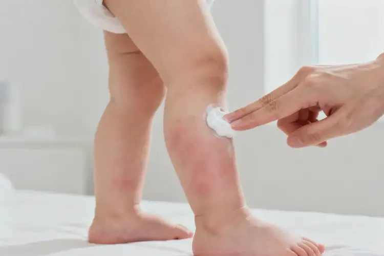 嬰兒小腿偶爾長濕疹能夠徹底治愈嗎(圖3)