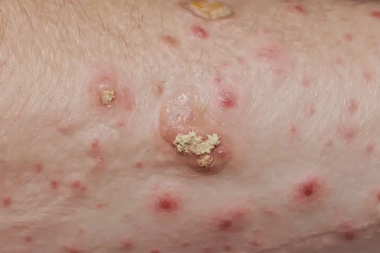 男人手臂出現(xiàn)濕疹不管它會自己自愈嗎(圖3)