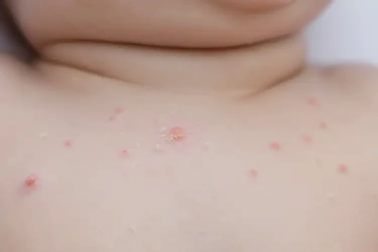 小兒脖子上出濕疹不管它會自己痊愈嗎(圖4)