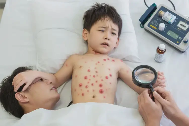 小兒肚子起濕疹可以徹底自愈嗎(圖4)