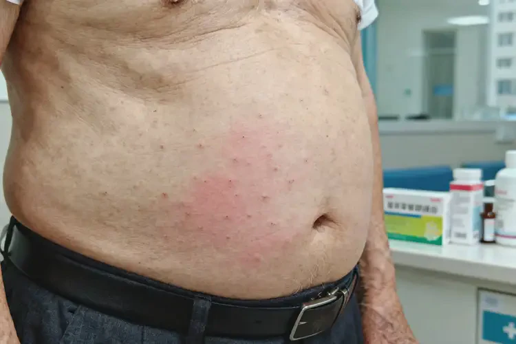 老人肚子上出現(xiàn)濕疹不管它會(huì)自己自愈嗎(圖2)