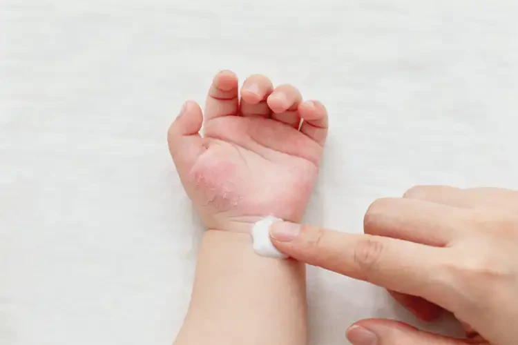 嬰幼兒手上偶爾長濕疹能夠徹底治愈嗎(圖3)