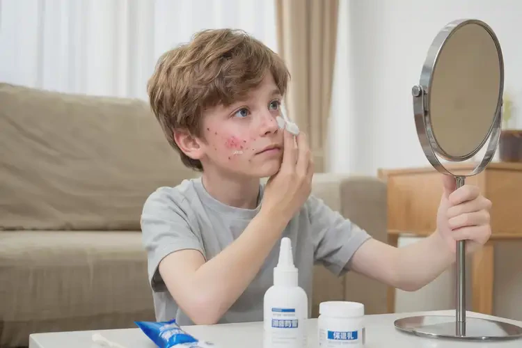 青少年面部起濕疹可以徹底自愈嗎(圖2)