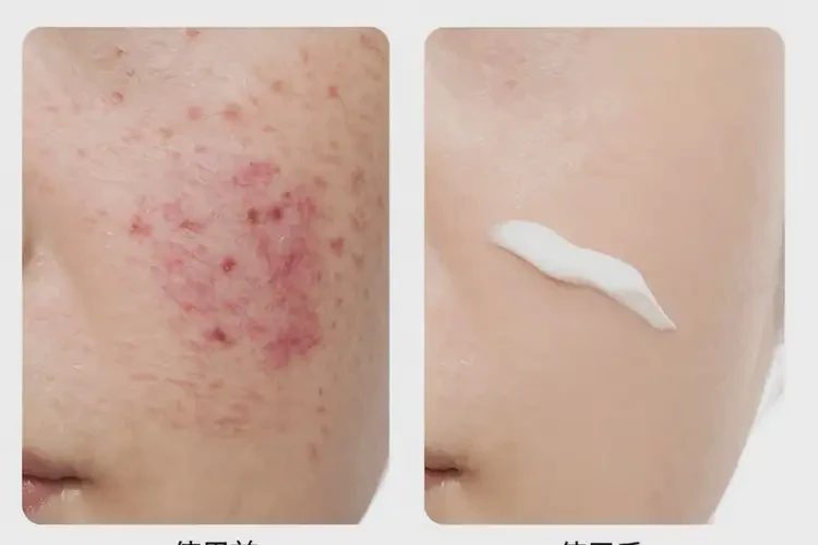 老人屁股上出濕疹可不可以徹底自愈(圖1)