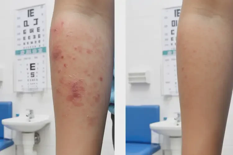 小孩手臂上長濕疹可以徹底自愈嗎(圖2)