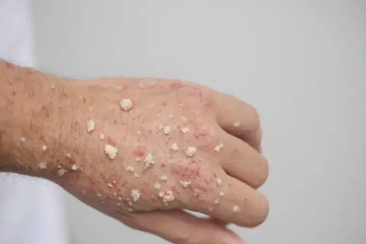 青年人手上出現(xiàn)濕疹不管它會自己痊愈嗎(圖4)