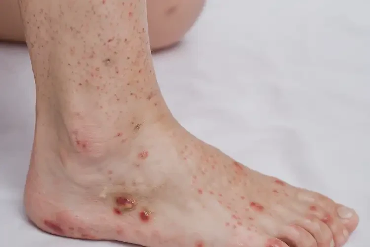 孕婦腳上有濕疹不管它會(huì)自己自愈嗎(圖4)