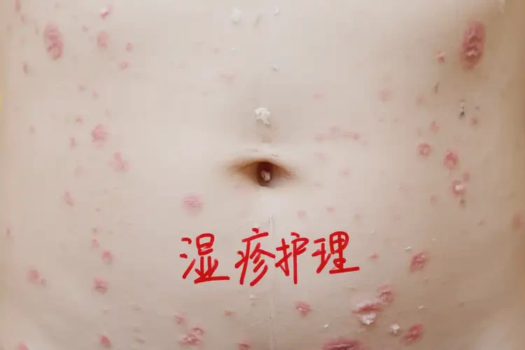 少兒肚子上出現(xiàn)濕疹不管它會(huì)自己痊愈嗎(圖4)