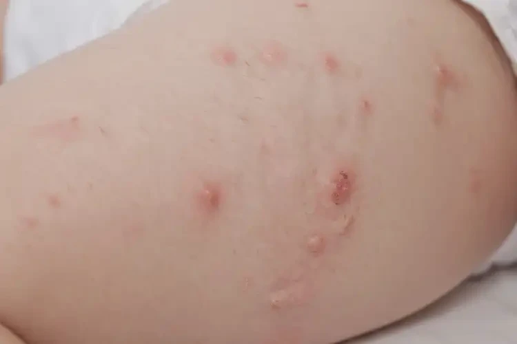 嬰幼兒大腿長濕疹能夠徹底治愈嗎(圖4)