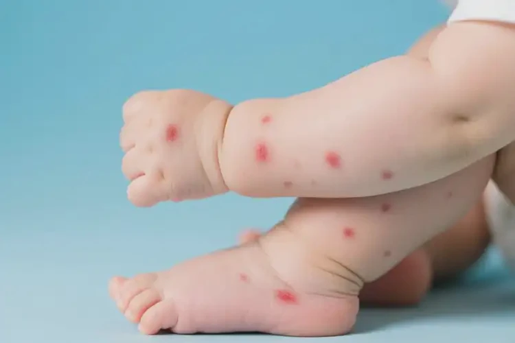 寶寶四肢出濕疹能靠自己自愈嗎(圖2)