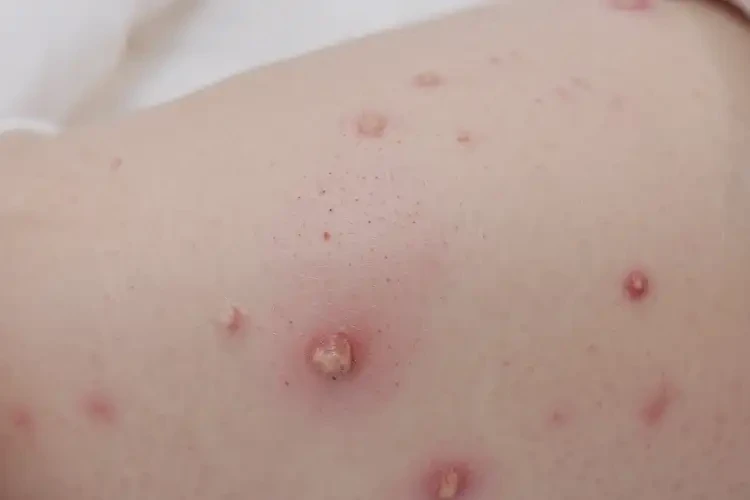 嬰兒大腿長濕疹能靠自己自愈嗎(圖4)