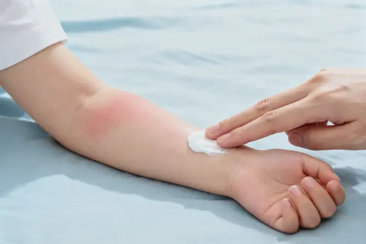 兒童手臂經(jīng)常起濕疹不管它會自己自愈嗎(圖2)