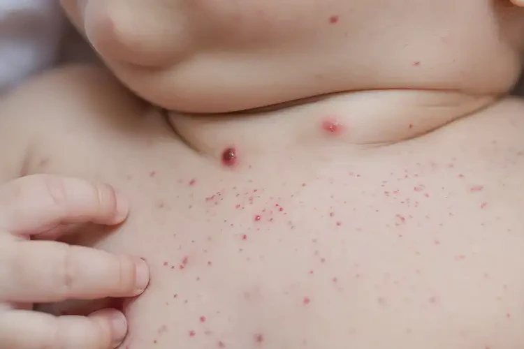 嬰兒脖子偶爾起濕疹能夠徹底治愈嗎(圖4)