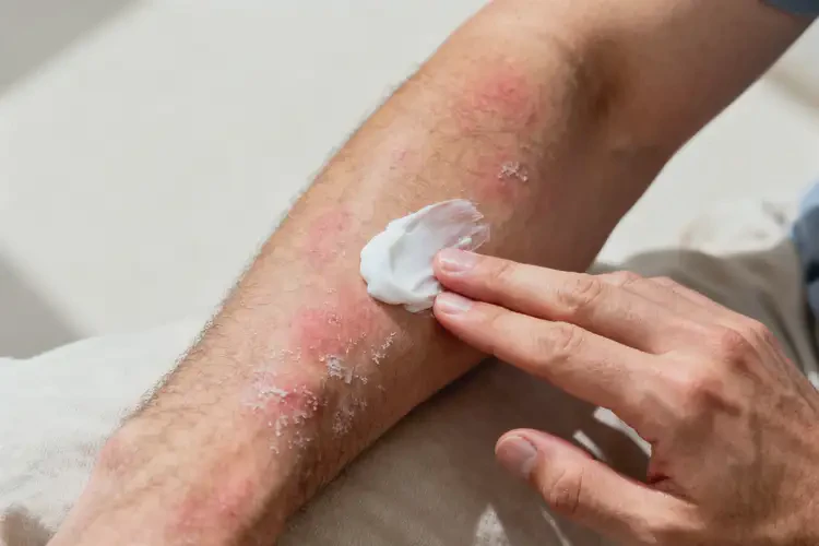 男人手臂上有湿疹能不能彻底自愈(图3)