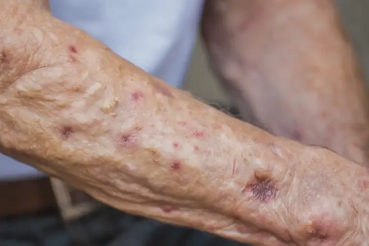 高齡老人手臂上偶爾起濕疹能徹底自愈嗎(圖4)