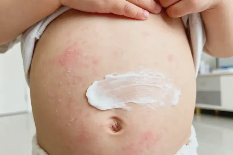 少兒肚子上偶爾長(zhǎng)濕疹不管它會(huì)自己自愈嗎(圖1)