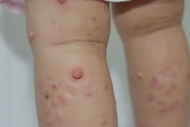 兒童小腿經(jīng)常起濕疹能靠自己自愈嗎(圖4)