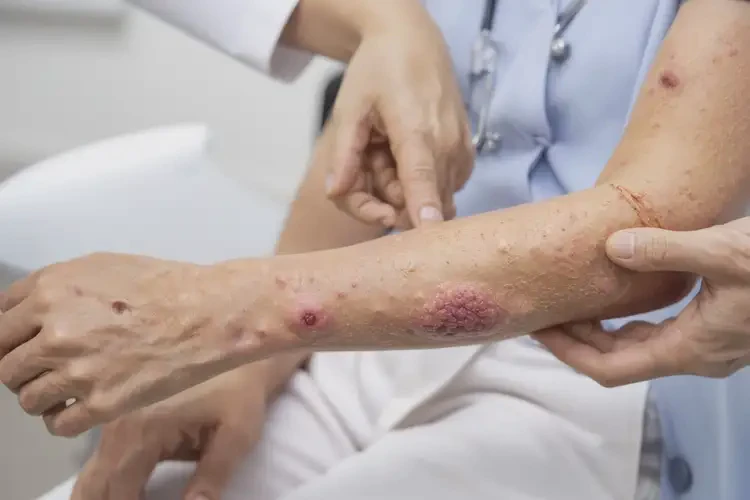 青年人大腿起濕疹不管它會自己自愈嗎(圖3)