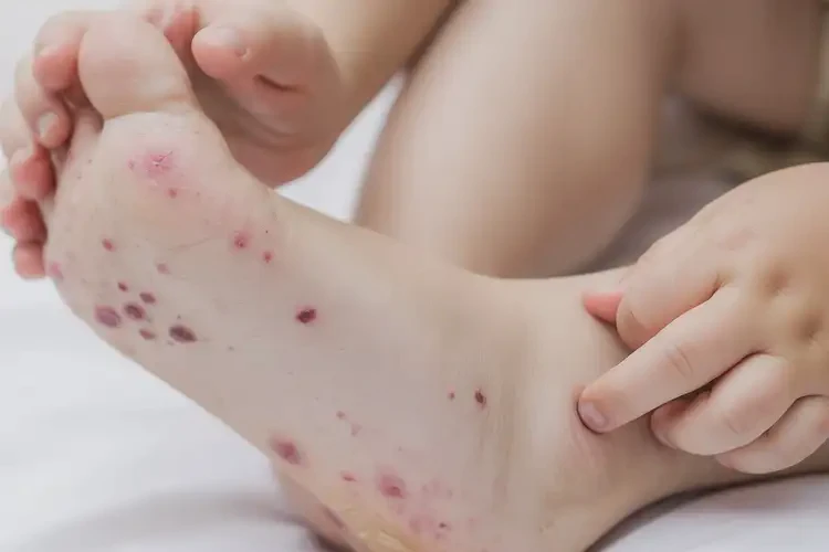 小孩腳上容易起濕疹不管它會自己好嗎(圖4)