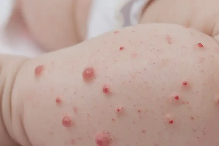 幼儿小腿起湿疹能够彻底治愈吗(图4)