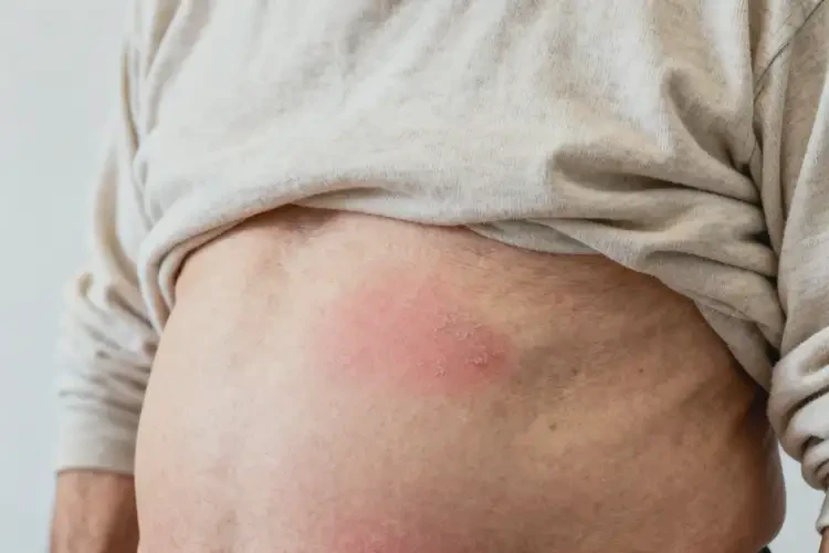 老年人肚子長濕疹不管它會自己自愈嗎(圖4)