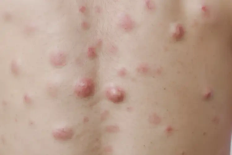 青年人手上偶爾起濕疹能徹底自愈嗎(圖4)