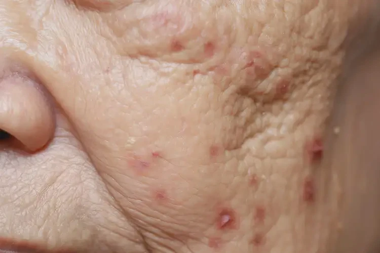 老年人屁股上經(jīng)常長濕疹能夠徹底治愈嗎(圖4)